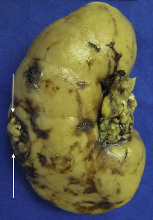 Riñón izquierdo afectado por metástasis de hepatocarcinoma.