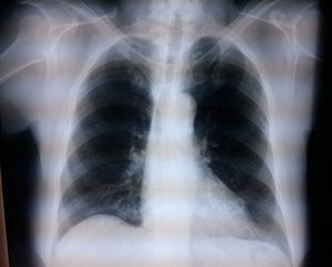 Radiografía de tórax posbloqueo interescalénico bilateral (caso 1) donde no se observa abatimiento de los hemidiafragmas, lo cual es indicativo de que no se presentó bloqueo del nervio frénico de ninguno de los 2 lados (la placa se tomó al finalizar la cirugía).