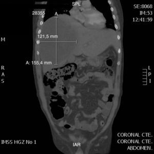 Tomografía computada de abdomen en la que se evidencia absceso hepático uniloculado.
