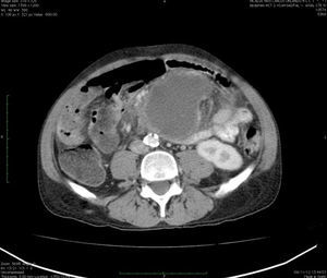 Tomografía donde se observa tumor quístico dependiente de intestino delgado.