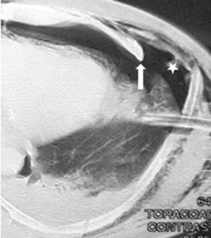 Imagen axial de estudio escanográfico muestra múltiples fracturas costales izquierdas desplazadas (flecha) y un importante grado de neumotórax (estrella). Nótese un aparente abombamiento y herniación pleural asociado. Además se observa la presencia de tubo de toracostomía izquierdo.