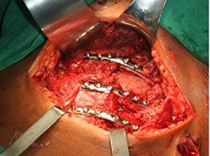 Imágenes intraoperatorias: placas de tercio de caña y tornillos de bicortical.