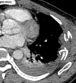Imagen axial de estudio escanográfico que confirma la presencia de múltiples fracturas costales izquierdas en 2 sitios diferentes, con un hemotórax asociado.