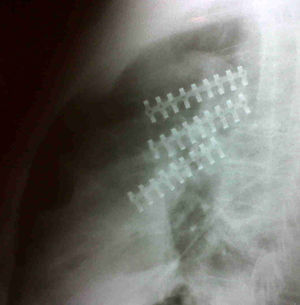 Control posquirúrgico. Radiografía de tórax. Proyección lateral que demuestra una corrección satisfactoria de las fracturas costales izquierdas, mediante la colocación de material de osteosíntesis.