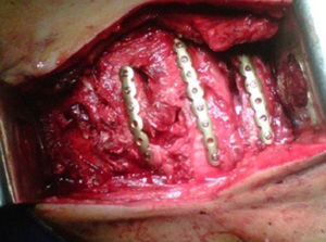 Imagen intraoperatoria. Placas de titanio bicortical bloqueadas universales que se moldearon.