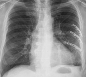 Control posquirúrgico. Radiografía de tórax. Proyección lateral muestra una reducción satisfactoria de las fracturas costales izquierdas mediante la colocación de material de osteosíntesis.