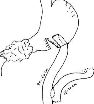 Técnica de gastro yeyuno anastomosis con separación gástrica parcial y reconstrucción en Y de Roux.