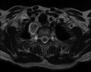 Resonancia magnética de unión cérvico-torácica. Corte axial en T2. Lesión ovoidea bien definida en mediastino superior.