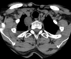 Tomografía computada torácica. Lesión en localización paravertebral derecha, posterior a la tráquea, y lateral al esófago.