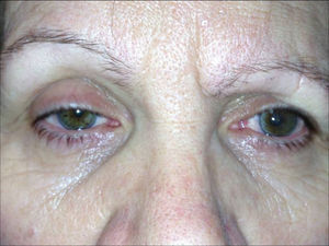 Imagen postoperatoria. Síndrome de Horner derecho. Se observa miosis, ptosis y enoftalmos del ojo derecho.