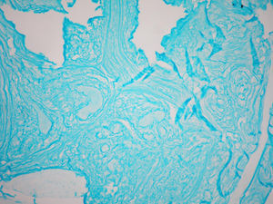 Corte histopatológico de adenocarcinoma mucinoso con tinción de azul alcián la cual podemos observar fuertemente positiva, ×100.