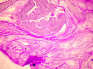 Isla de células neoplásicas inmersas en matriz de mucina ácido peryódico de Schiff (PAS, por sus siglas en inglés) positivo, característico del adenocarcinoma mucinoso.