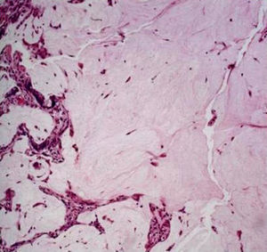 Células neoplásicas vacuoladas de adenocarcinoma inmersas en una matriz abundante de mucina. Las paredes alveolares se encuentran deformadas por la proliferación neoplásica. Hematoxilina y eosina, ×200.