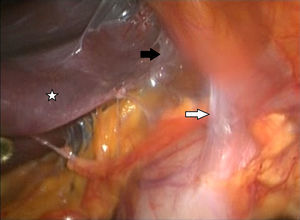Se aprecia hígado (estrella blanca) con abundantes adherencias hígado-pared (flecha negra), estómago-pared (flecha blanca).