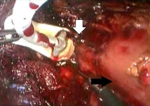 Se observa la extracción laparoscópica de la banda gástrica. Sitio de penetración (flecha blanca), estómago (flecha negra).