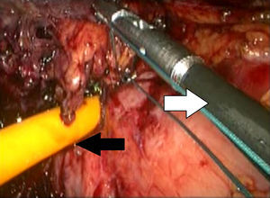 Realización de jareta de gastrostomía vía laparoscópica, baja nudos (flecha blanca), sonda Foley en sitio de erosión (flecha negra).