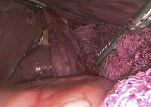 Estructura tubular disecada. Se observa la continuidad desde su emergencia hepática hasta su porción retroduodenal. No se visualiza conducto cístico ni vesícula biliar.