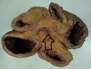 La flecha muestra la fibrosis mesentérica secundaria a la reacción desmoplásica causada por el carcinoide intestinal.
