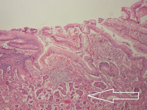 Grupo de células correspondientes a neoplasia neuroendocrina grado1 (tumor carcinoide) que infiltra la lámina propia, muscular de la mucosa, submucosa, muscular propia y serosa.