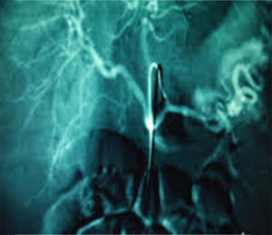 Arteriografía mesentérica que muestra la extravasación del contraste administrado a nivel de la arteria esplénica por rotura de un seudoaneurisma pancreático.