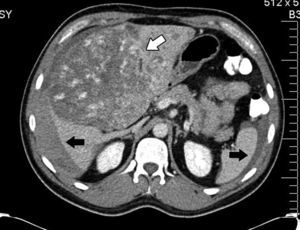 Tomografía axial computada abdominal con contraste oral e intravenoso en fase arterial que muestra líquido libre en cavidad abdominal, de predominio perihepático y periesplénico (flechas negras) así como una lesión redondeada, heterogénea a la captación de medio de contraste que ocupa prácticamente la totalidad del hígado (flecha blanca).