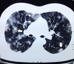 Tomografía axial computada de tórax, ventana pulmonar; se observan lesiones sólidas pequeñas y redondeadas, con signo del halo (flechas blancas), imágenes en vidrio despulido (cabeza de flecha).