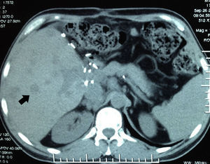 Tomografía axial computada abdominal simple. Múltiples lesiones redondeadas, hipodensas en injerto hepático (flecha negra).