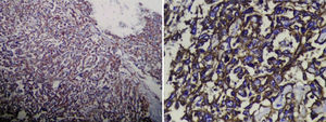 Histología, células endoteliales que se agrupan en cordones, invaden espacios vasculares y son positivas para CD31 y CD34.