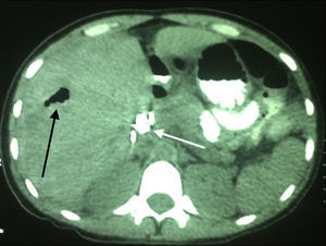 Corte axial de tomografía abdominal contrastada, sin presencia de lesión hepática. Se observa aire en vía biliar intrahepática (esperada tras colangiopancreatografía retrógrada endoscópica) y la presencia de stents en la vía biliar extrahepática (flecha negra y blanca respectivamente).