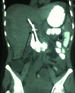Corte coronal de tomografía abdominal contrastada; se observa la presencia de stent en la vía biliar extrahepática (flecha negra), sin evidencia de lesión hepática.
