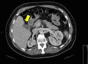 Tomografía computada abdominal en la que se evidencia: trombosis de la vena porta izquierda secundaria a colecistitis aguda litiásica (flecha blanca).
