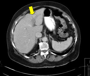 Tomografía computada abdominal en la que se observa: trombosis de la vena porta izquierda, secundaria a colecistitis aguda litiásica (flecha blanca).