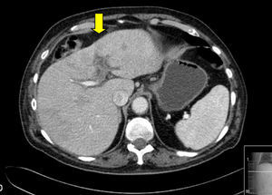 Tomografía computada abdominal en la que se señala con flecha blanca trombosis de la vena porta izquierda, secundaria a colecistitis aguda litiásica.