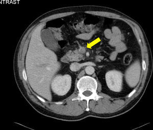 Tomografía computada abdominal en la que se evidencia: tromboflebitis de la vena mesentérica superior y ramas portales (flecha blanca) secundarias a apendicitis aguda gangrenosa.