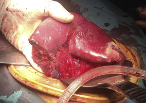 Control total del sangrado, con viabilidad del 75% del órgano remanente, que se decide preservar.