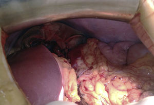 Imagen intraoperatoria al concluir el procedimiento y disponer el órgano remanente preservado en la celda esplénica.