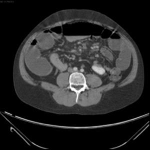 Corte axial de tomografía con doble contraste que muestra múltiples ganglios abdominales aumentados de tamaño.
