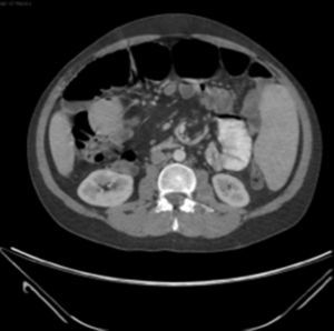Corte axial de tomografía con vasos mesentéricos de trayecto anormal (signo del remolino).