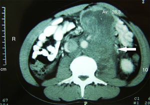 Tomografía axial. Se observa un tumor retroperitoneal de 6×13cm.