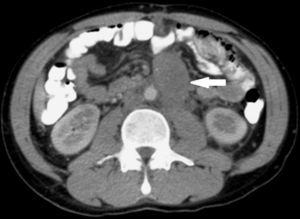 Tomografía axial computada. Se observa imagen de tumor retroperitoneal posquimioterapia de 6cm.
