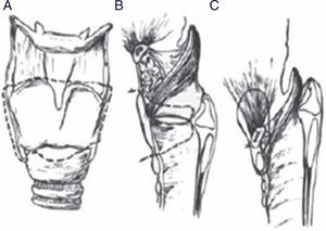 Detalle de la técnica quirúrgica de la laringectomía subtotal; resección completa del espacio paraglótico, extirpándose el cartílago tiroides; la reconstrucción laríngea se logra fijando el cricoides a la epiglotis, hioides y base de la lengua.