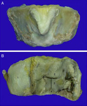 Espécimen de laringectomía subtotal supracricoidea. A.Vista anterior. B.Vista posterior. 1:pared posterior del cartílago tiroides; 2:banda ventricular; 3:cuerda vocal; 4:ventrículo de Morgagni; 5:comisura anterior; 6:espacio paraglótico.