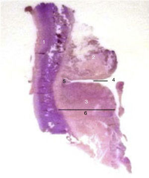 En el corte sagital se identifican las siguientes estructuras: 1:cartílago tiroides; 2:banda ventricular; 3:cuerda vocal; 4:ventrículo de Morgagni; 5:comisura anterior; 6:espacio paraglótico.