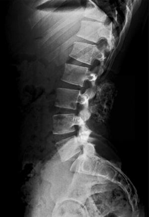 Radiografía lateral de columna lumbosacra, donde se observa tumoración de 7cm aproximadamente.