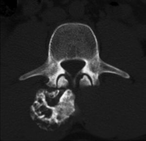 Corte axial de tomografía computada a nivel de cuerpo vertebral de L3. Se observa osteocondroma en la región posterior derecha.