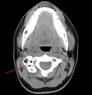 Tomografía computada corte axial de columna cervical. Se observa neoformación de tejido óseo en C1 con extensión a C2.