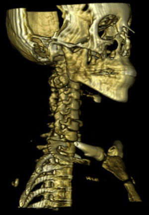 Tomografía axial computada con reconstrucción ósea de columna cervical, se observa tumoración ósea a nivel de C2.