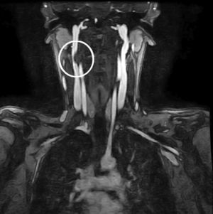 Angiotomografía axial computada de columna cervical, corte coronal. Dentro del círculo se observa moldeamiento de la arteria vertebral derecha.