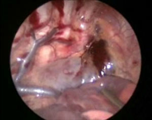 Imagen toracoscópica inicial en donde se aprecia un hematoma en el tercio superior del mediastino posterior.
