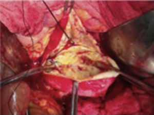 Apertura del saco aneurismático y mediante control con sondas balón de Fogarty 3Fr del ostium proximal y distal; se procede a la endoaneurismorrafia.